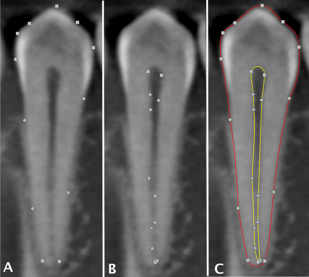 Measuring pulp to tooth area ratio in a CBCT dental scan
