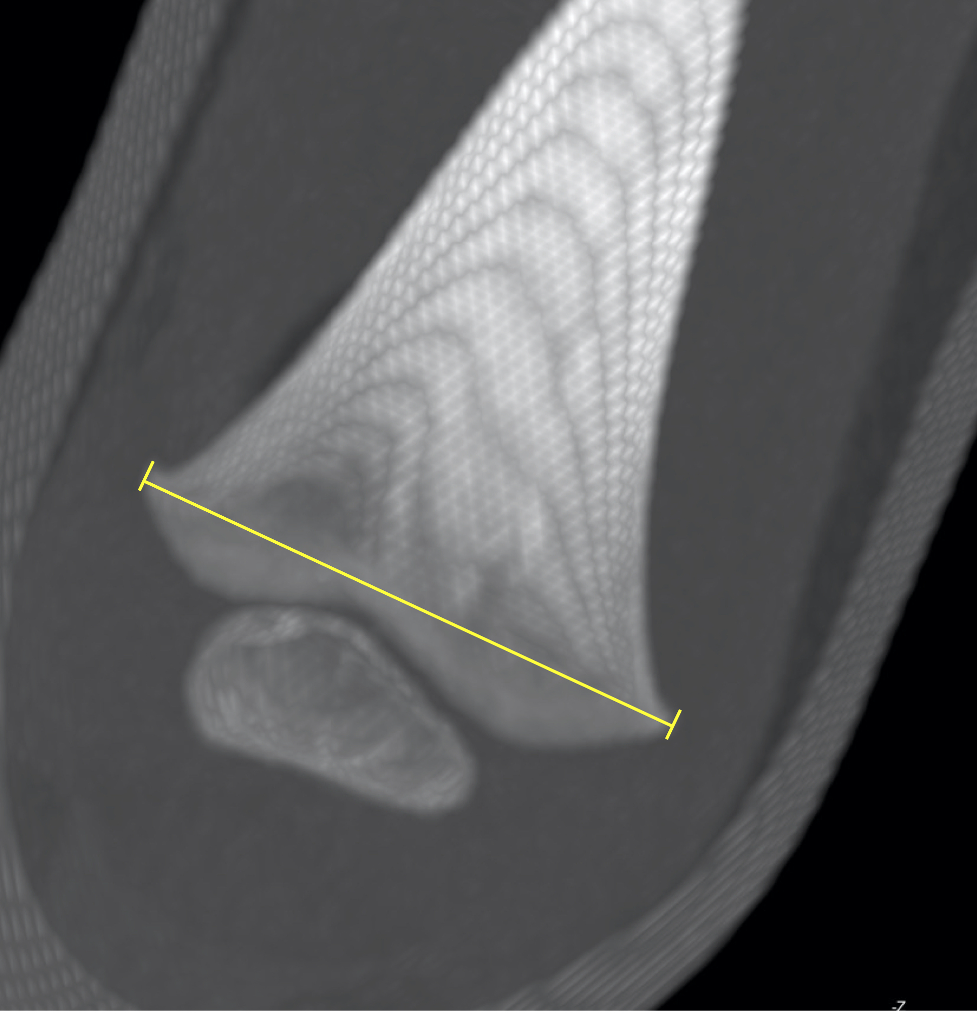 Illustration measurement of the distal femoral metaphysis in a CT scan